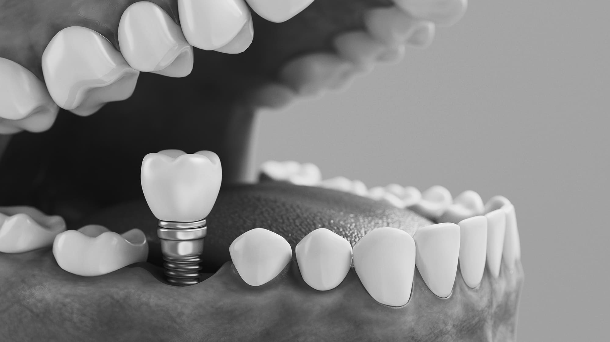 Εμφυτεύματα